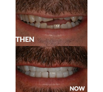 Adult Thumb Sucker at Start Smiling Dentist in Essex