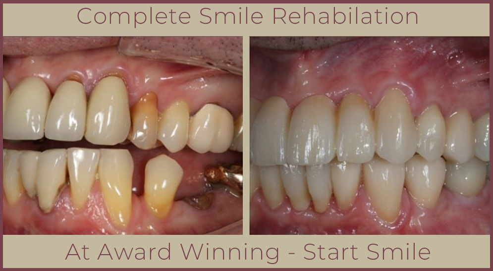 Crowns and Bridges At Start Smiling Dentist