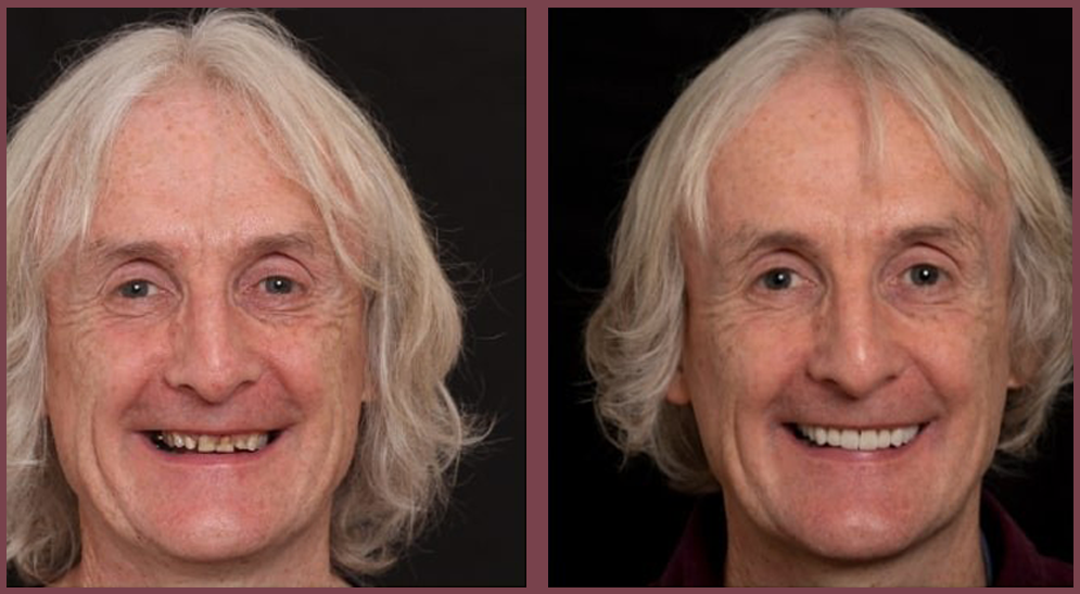 Crowns and Bridges At Start Smiling Dentist in Essex