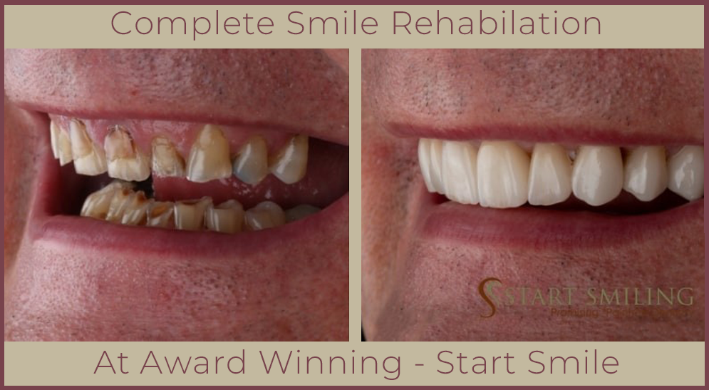 Crowns and Bridges At Start Smiling Dentist