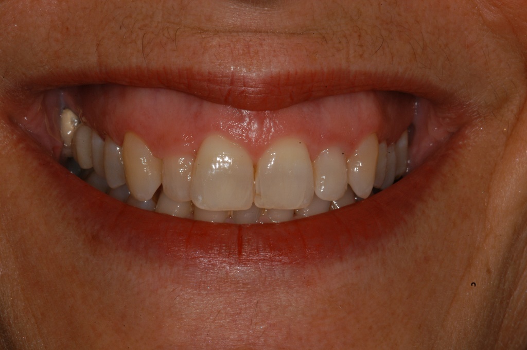 Smilefast at Start Smiling Dentist in Essex