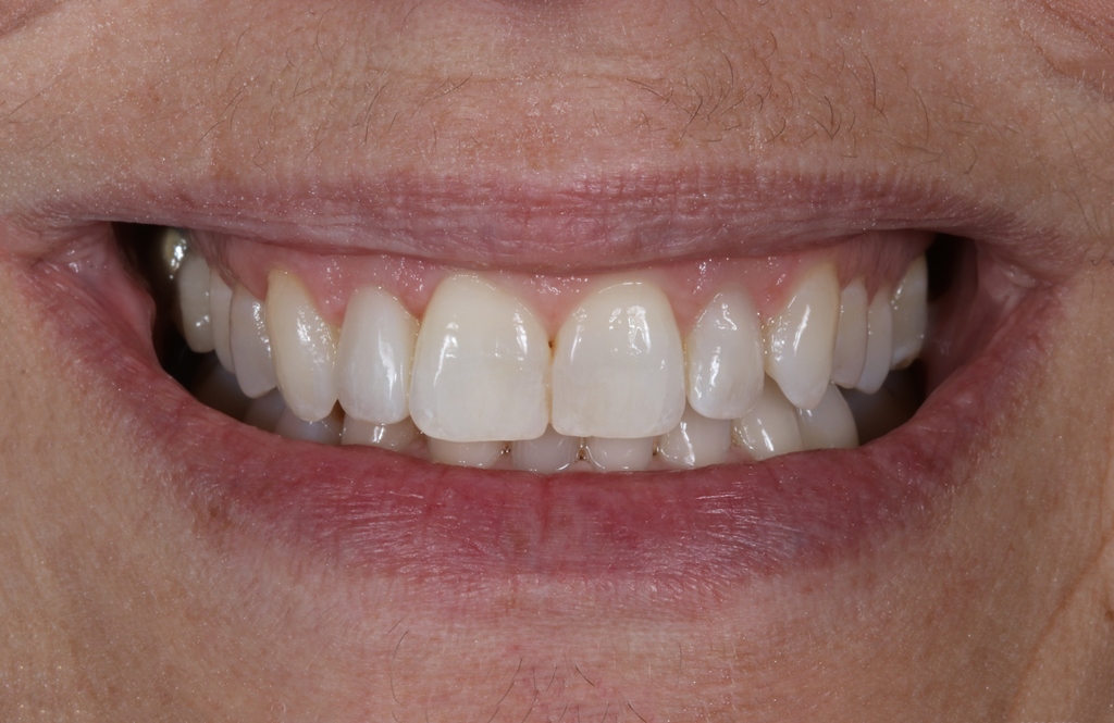 Smilefast at Start Smiling Dentist in Essex