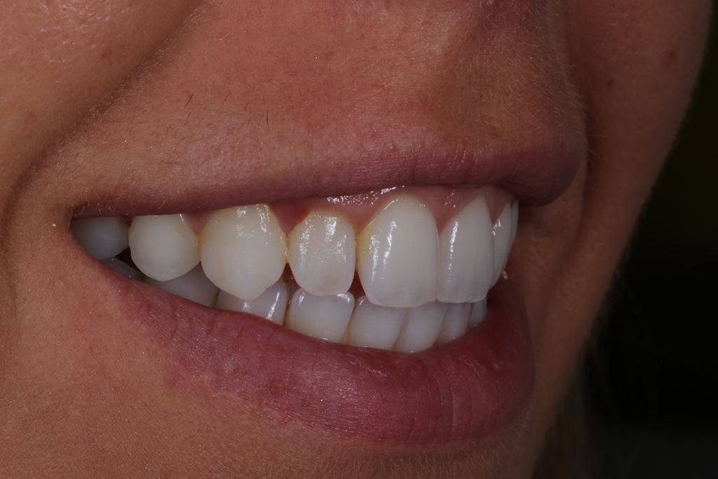 Smilefast at Start Smiling Dentist in Essex