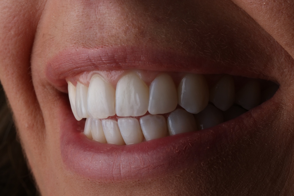 Smilefast at Start Smiling Dentist in Essex