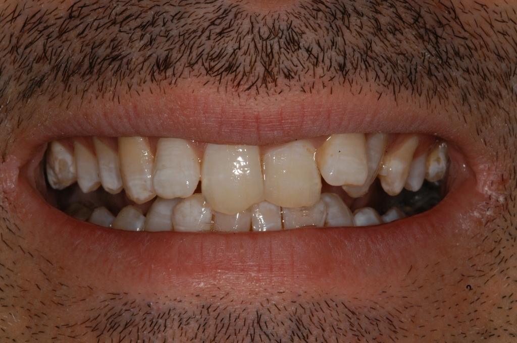 Smilefast at Start Smiling Dentist in Essex