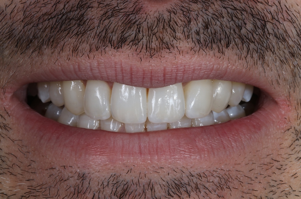 Smilefast at Start Smiling Dentist in Essex