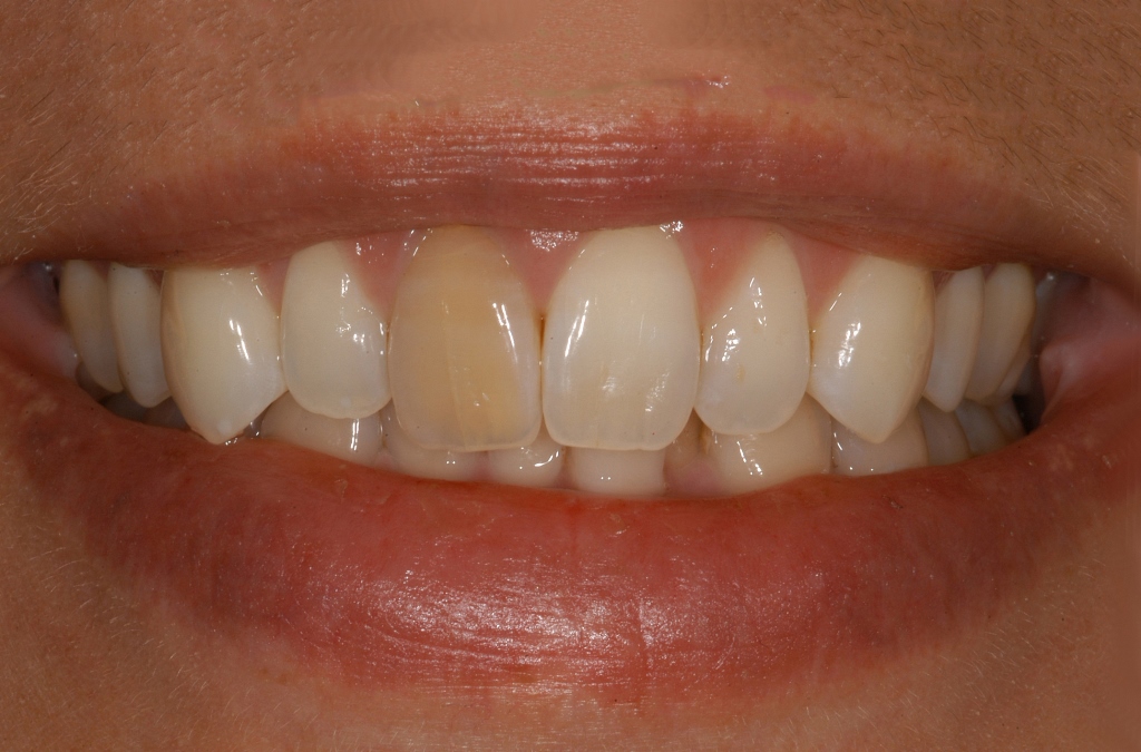 Smilefast at Start Smiling Dentist in Essex