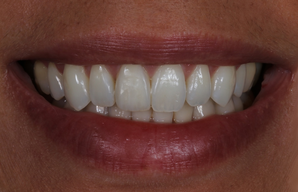 Smilefast at Start Smiling Dentist in Essex