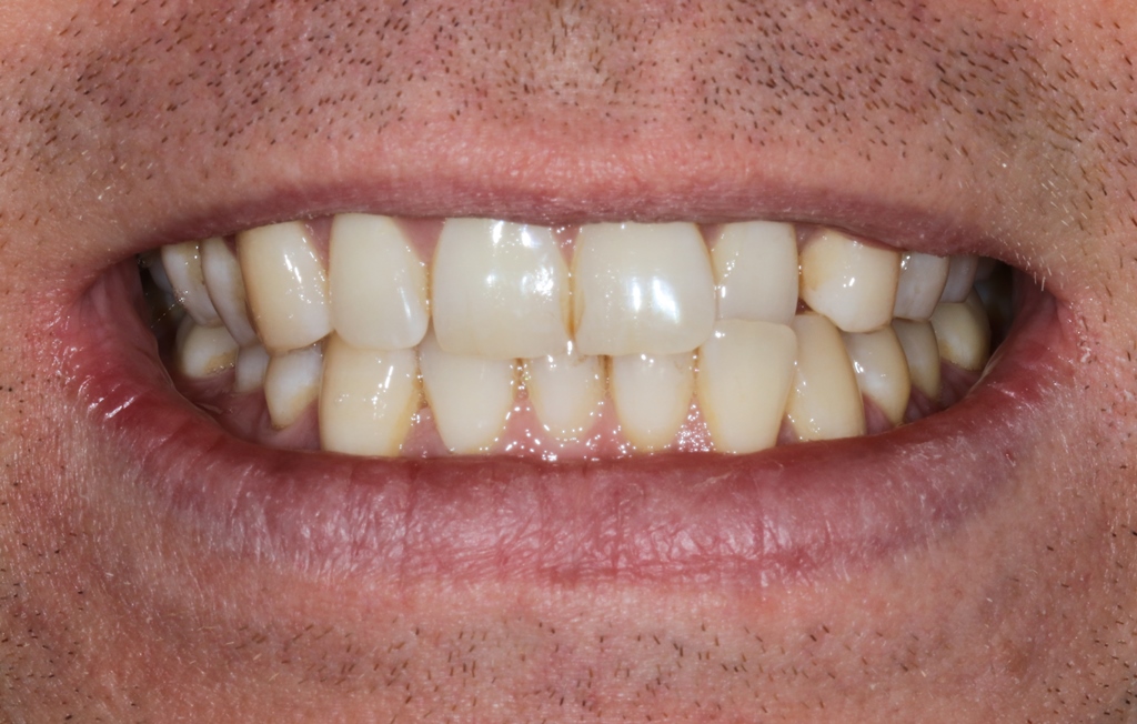 Smilefast at Start Smiling Dentist in Essex