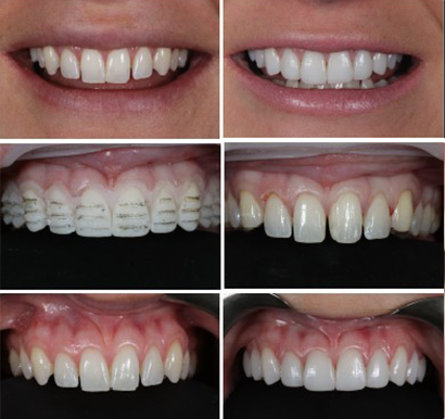 Dental Veneers at Start Smiling Dentist in Essex
