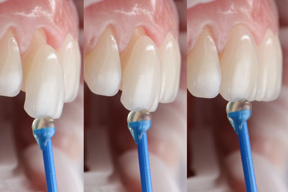 Dental Veneers at Start Smiling Dentist in Essex